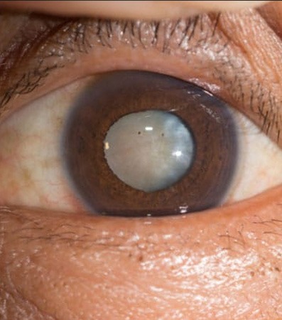Cataract before Surgery