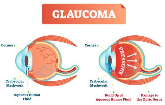 Glaucoma Symptoms
