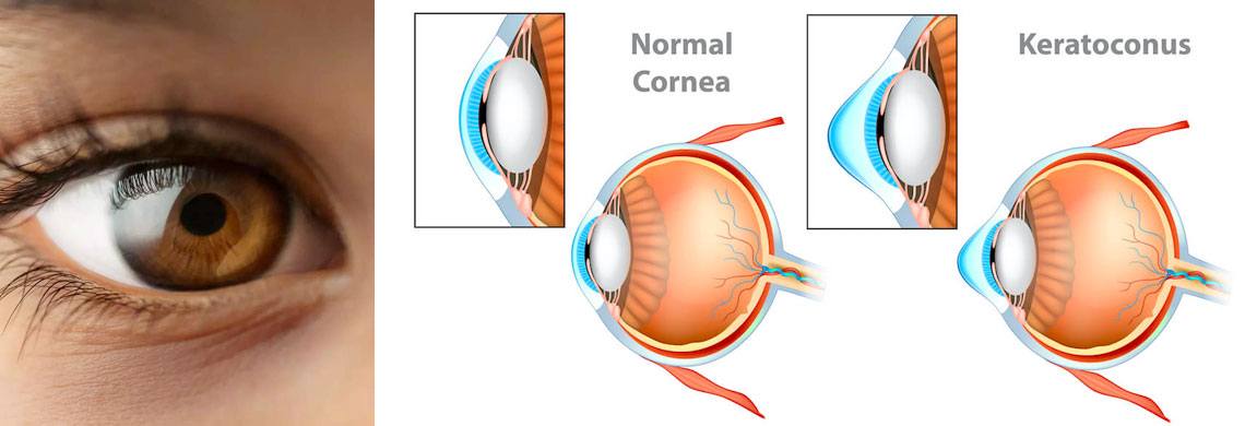 How to see better after keratoconus Treatment