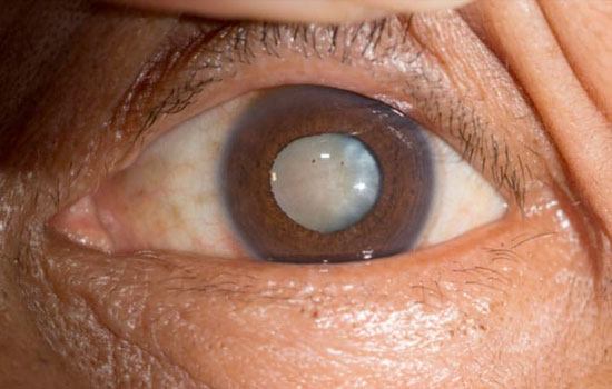 Best Cataract surgery hospital in Ghaziabad