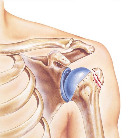 Shoulder Replacement Surgery Diagram