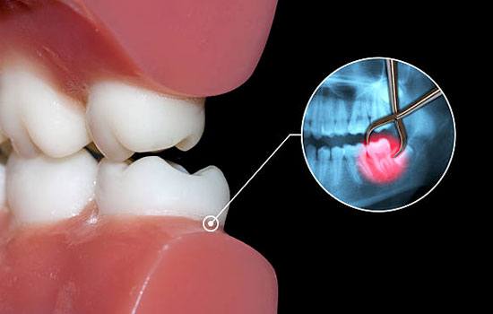 Wisdom Tooth Removal Surgery in Ghaziabad