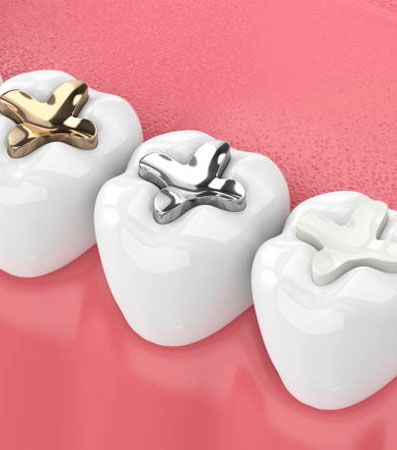 Composite fillings, Tooth colored fillings
