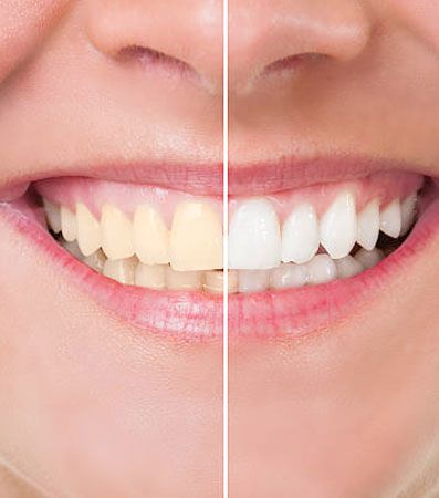Teeth Whitening Treatment in Ghaziabad