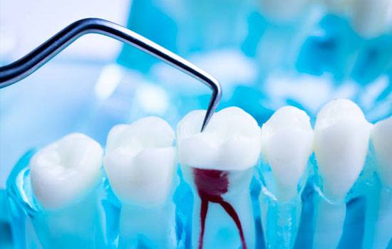 Root Canal Treatment Causes