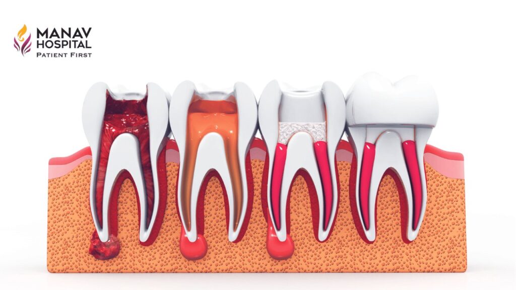 Root Canal Treatment in Ghaziabad