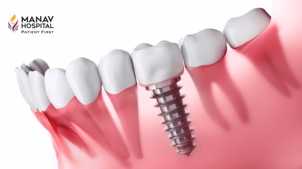 Dental Implants in Ghaziabad