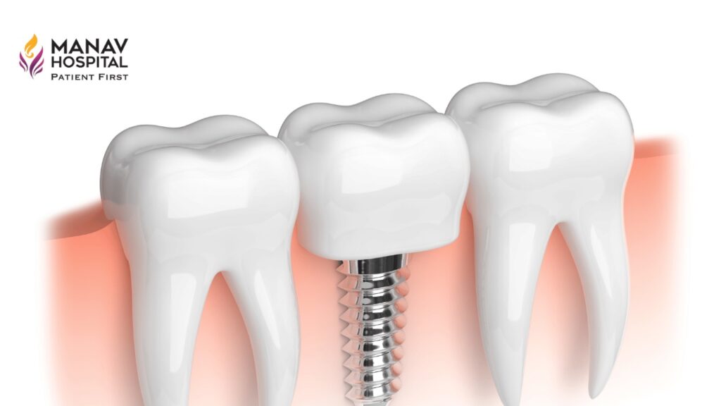 Dental Implants in Ghaziabad